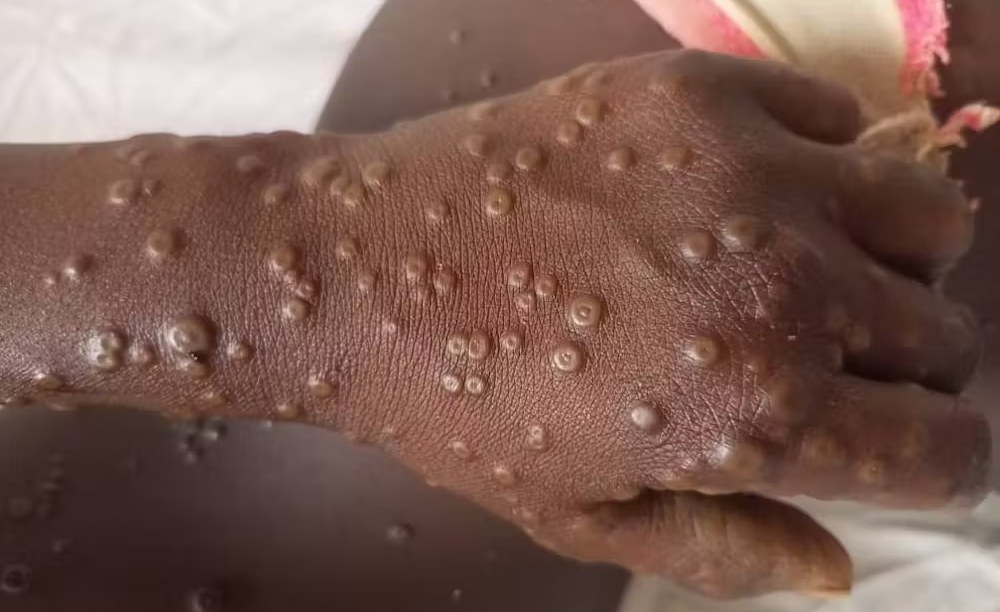 monkeypox virus disease outbreak