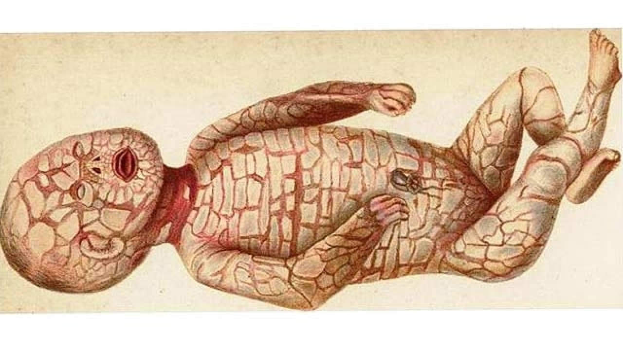 harlequin type ichthyosis