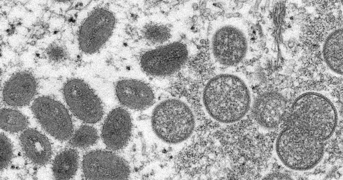 monkeypox virus outbreak