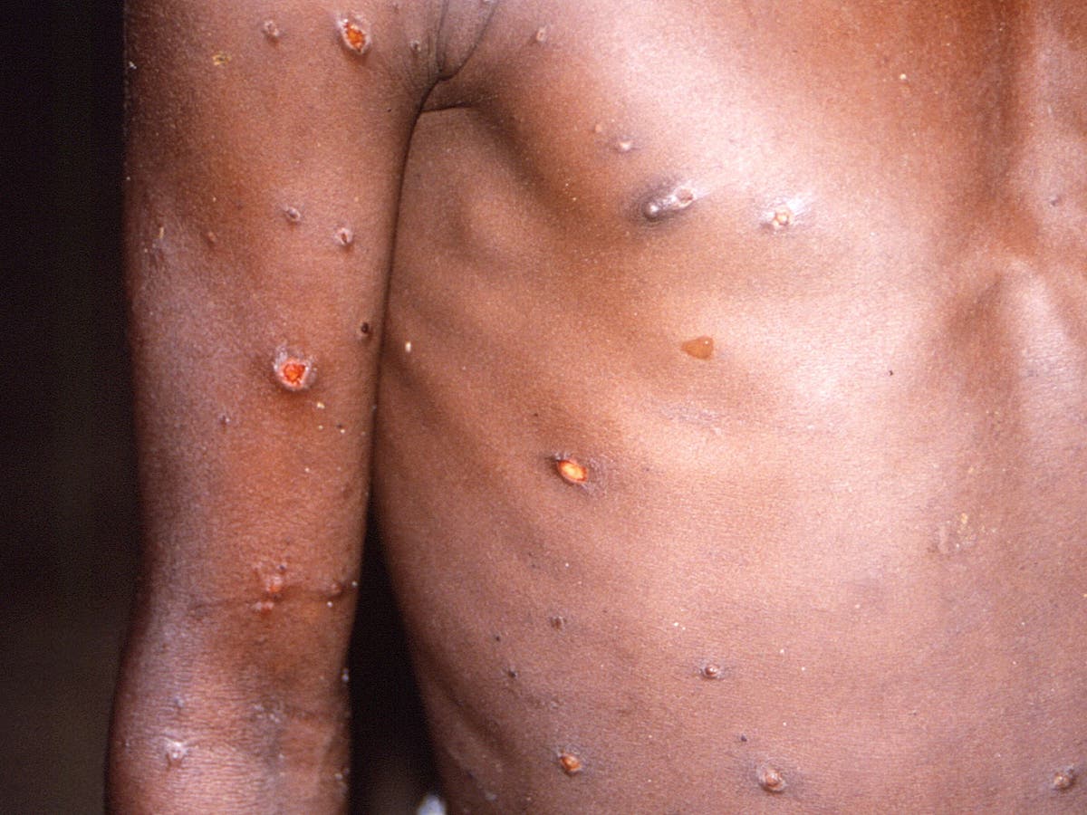 what is monkeypox